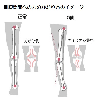 正常な膝との違い