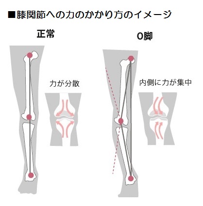 正常な膝との違い