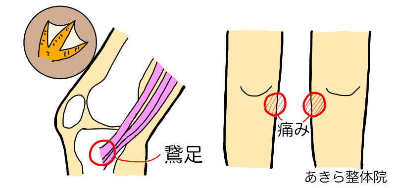 膝の痛み