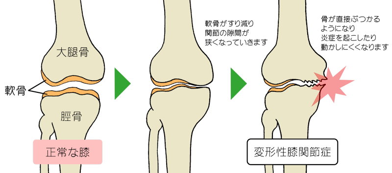 変形性膝関節症