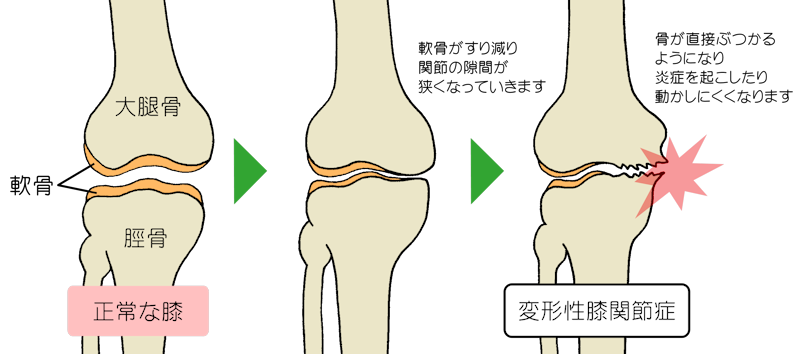 変形性膝関節症の経過