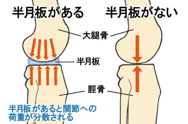 半月板がない場合の負担