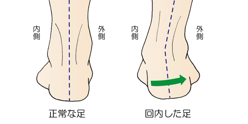 足の回内